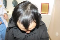 -大麦微针植发丨全国连锁