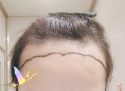 -大麦微针植发全国连锁