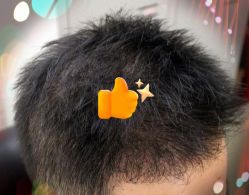 -大麦微针植发全国连锁