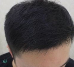 -大麦微针植发丨全国连锁