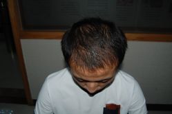 -大麦微针植发丨全国连锁