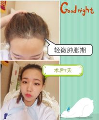 -大麦微针植发全国连锁