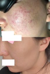 -美肤盾祛痘·问题肌头疗管理中心