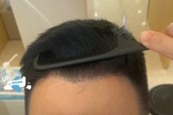 -大麦微针植发丨全国连锁