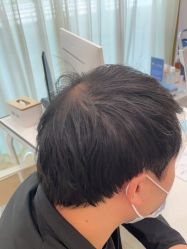 点击看大图 -碧莲盛·不剃发植发