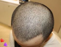 -大麦微针植发丨全国连锁