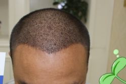 -大麦微针植发丨全国连锁