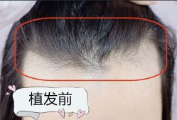 -大麦微针植发全国连锁