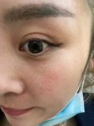 体验后-紫洁俪方（北京）医疗美容