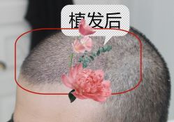 -大麦微针植发全国连锁