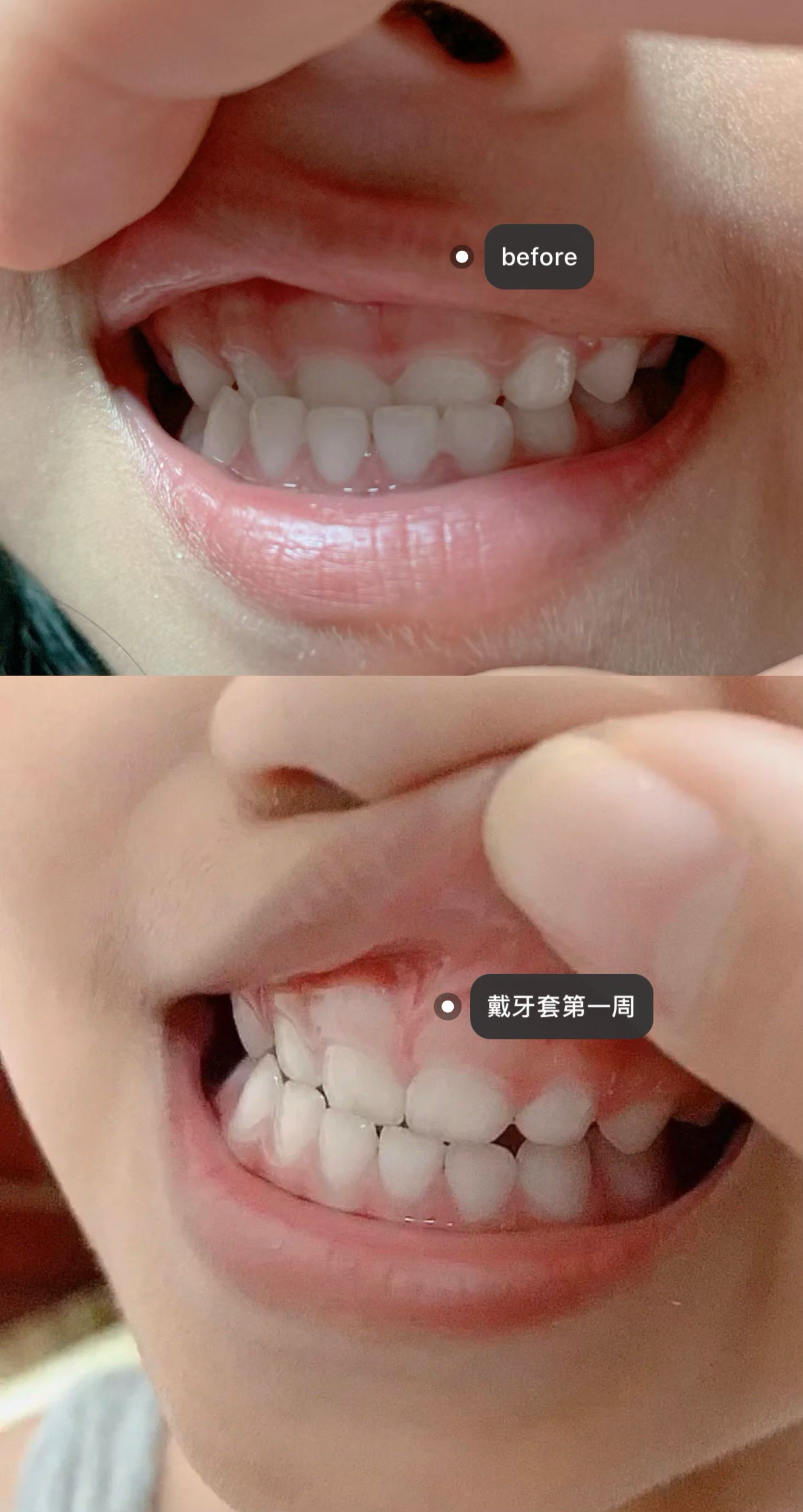 牙齿矫正#地包天#儿童矫正#西安牙齿矫正
真的太感谢#瑞泰口腔 宋