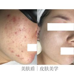 -美肤盾祛痘·问题肌头疗管理中心