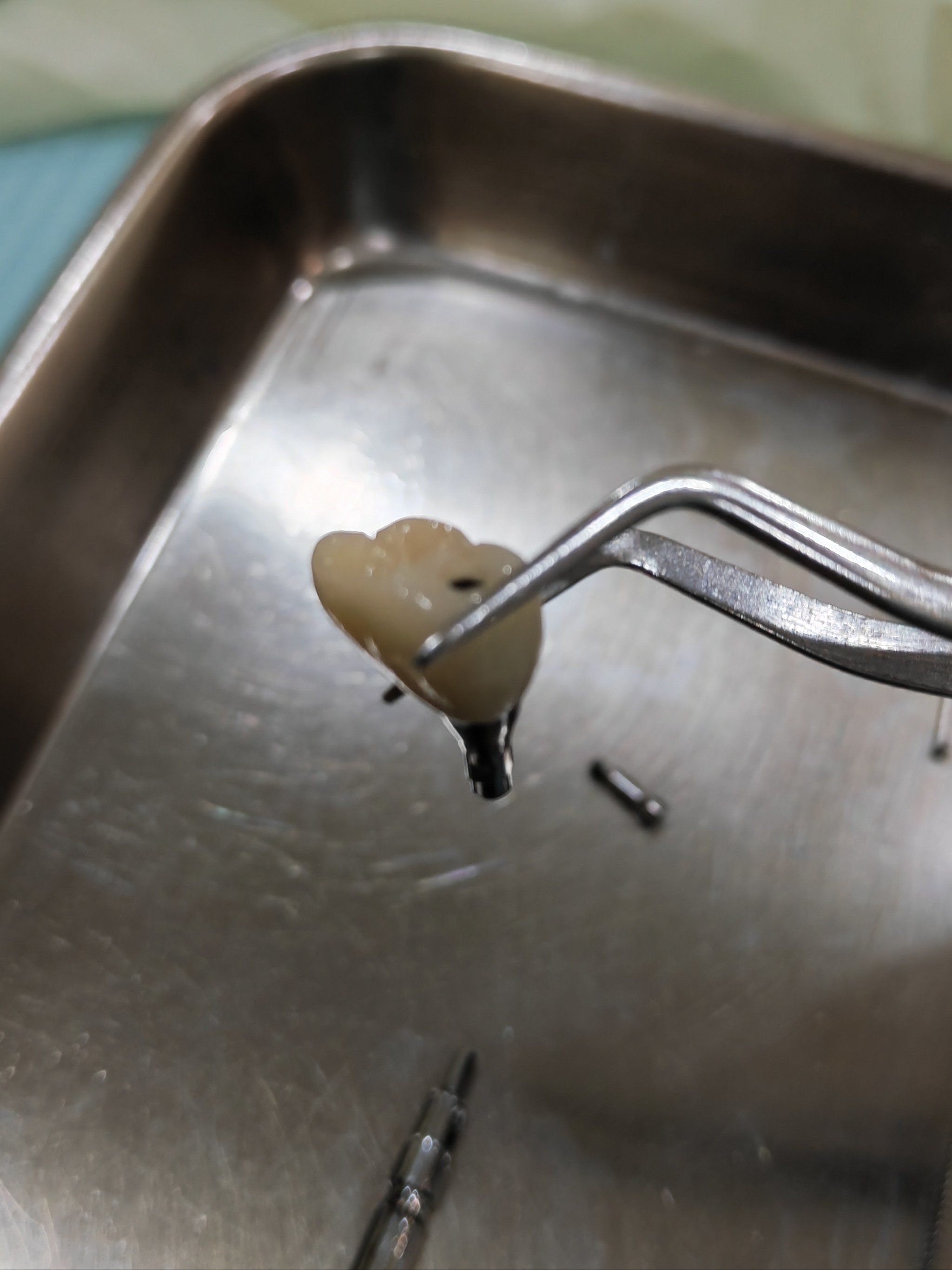 去医院洗牙,结果发现左上7号大牙松动,医生给的建议是牙龈萎缩严重