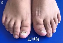-德哥灰指甲脚气甲沟炎跖疣护理