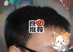 -大麦微针植发全国连锁