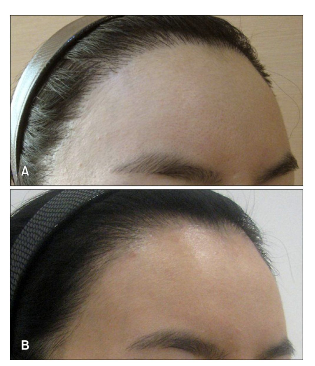 纹发际线前后对比,重拾自信边缘