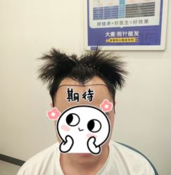 -大麦微针植发全国连锁