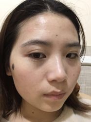-美丽人生祛斑扁平疣汗管瘤中心