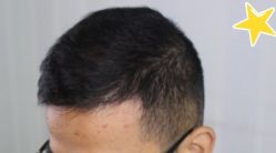 -大麦微针植发丨全国连锁