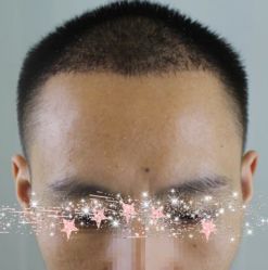 -大麦微针植发丨全国连锁