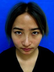 -广州健丽·去眼袋医疗美容机构