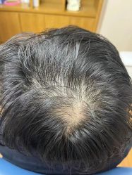 -大麦微针植发全国连锁