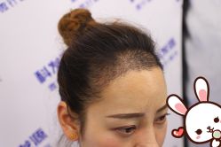 -大麦微针植发丨全国连锁