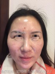 脸部抗衰-光SPA科技美肤