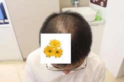 -大麦微针植发丨全国连锁