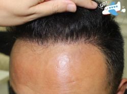 -大麦微针植发丨全国连锁