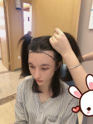 -大麦微针植发丨全国连锁