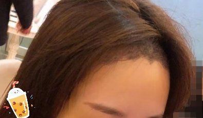 -大麦微针植发丨全国连锁