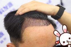 -大麦微针植发丨全国连锁