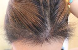 -大麦微针植发丨全国连锁