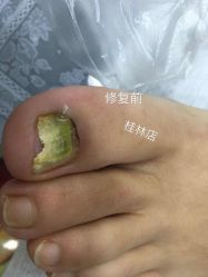 -德哥灰指甲脚气甲沟炎跖疣护理