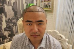 点击看大图 -大麦微针植发丨全国连锁