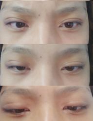 点击看大图 体验后-禾美嘉医疗美容