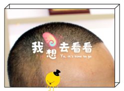 -大麦微针植发全国连锁