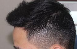 -大麦微针植发丨全国连锁