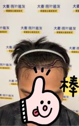 -大麦微针植发全国连锁