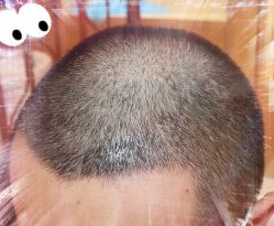 -大麦微针植发全国连锁