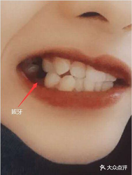 牙齿矫正‖如何判断自己需不需要拔牙