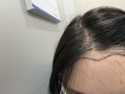 -碧莲盛不剃发植发