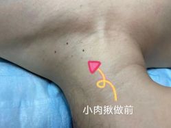 -美丽人生祛斑扁平疣汗管瘤中心