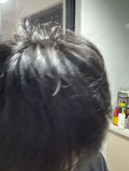 -大麦微针植发丨全国连锁