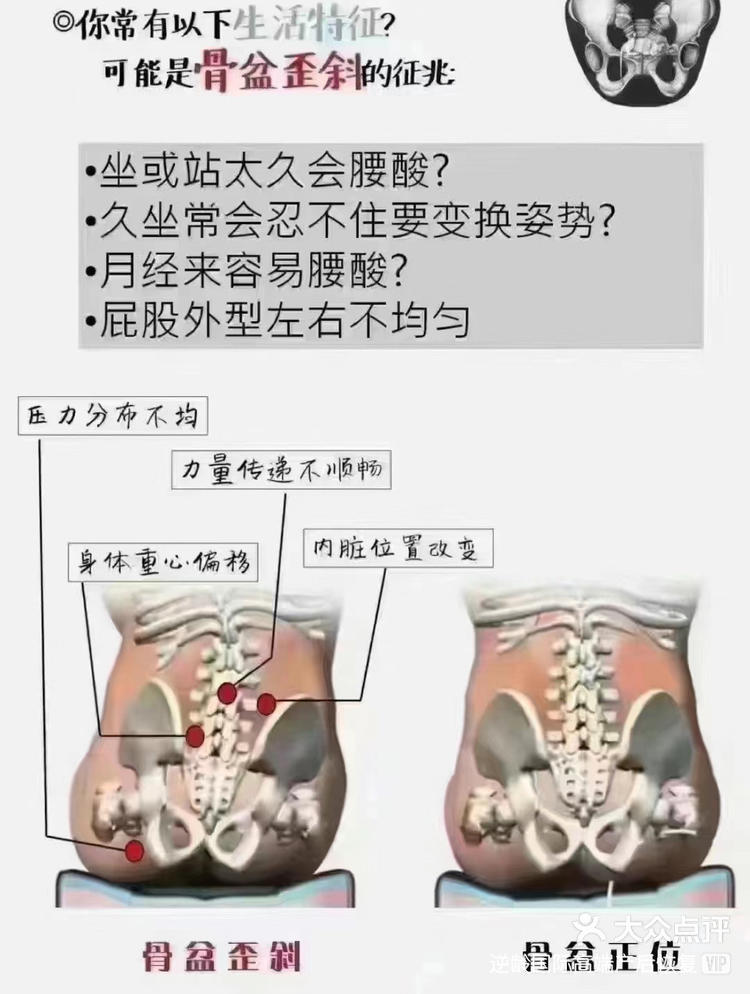 骨盆的重要标志图片