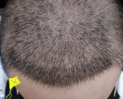 -大麦微针植发丨全国连锁