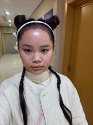 -大麦微针植发全国连锁