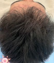 -大麦微针植发丨全国连锁