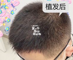 -大麦微针植发全国连锁